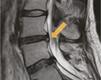 치료 후 MRI